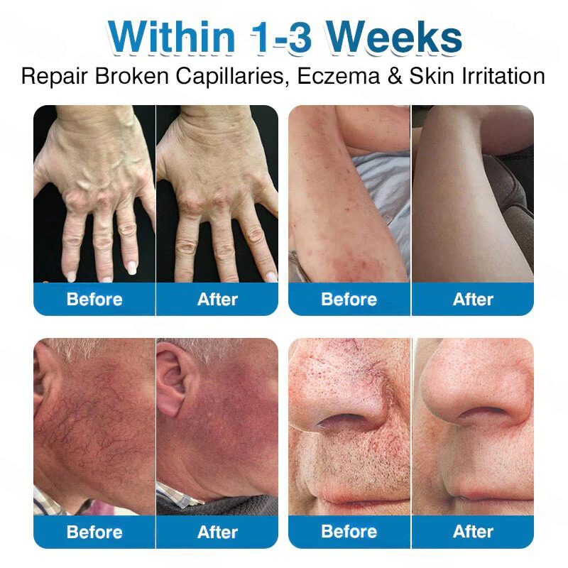 🏅🏃OUR+ Microneedle Patch Roll⚡Instant Relief, Long-Term Results✨