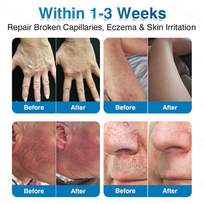 🏅🏃OUR+ Microneedle Patch Roll⚡Instant Relief, Long-Term Results✨